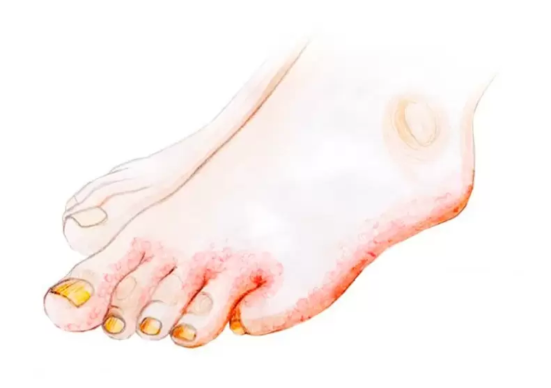 Fungus on the toes and how to use Zenidol cream
