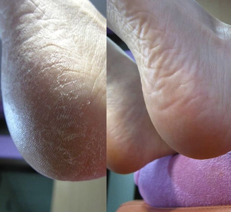 Photos of heels before and after applying Zenidol cream