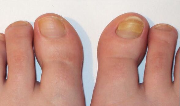 toenail fungus symptoms