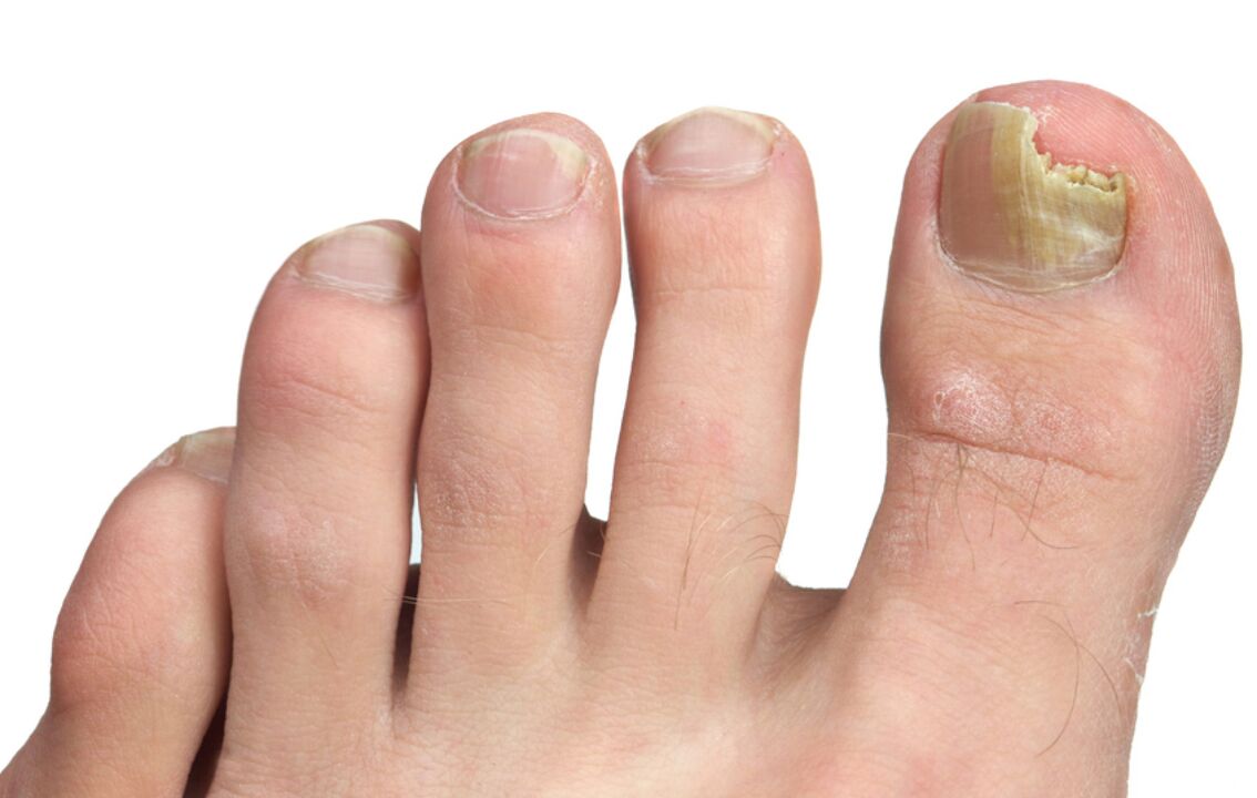 photos of toenail fungus