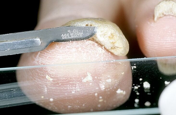 scrape nails to diagnose fungus