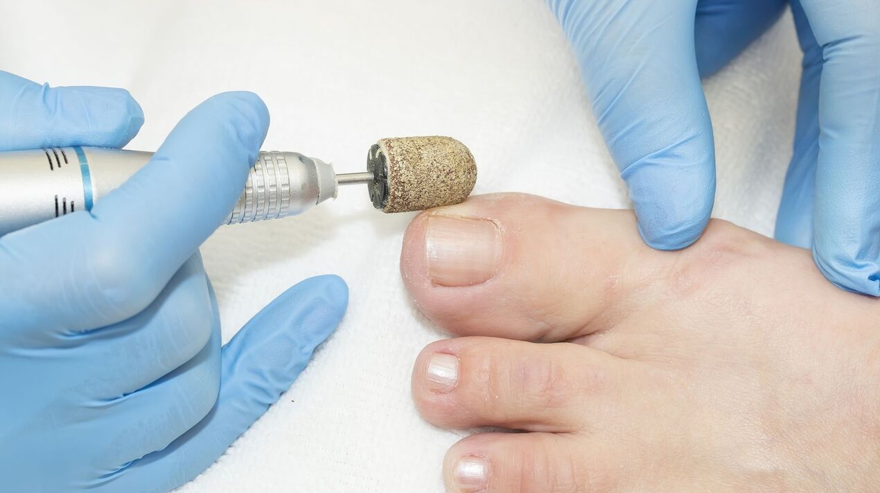 hardware treatment of fungus on toenails