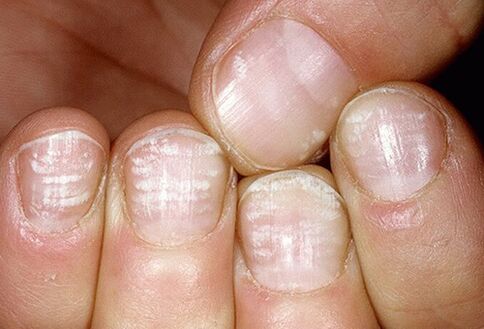 fungal infections on nail plates
