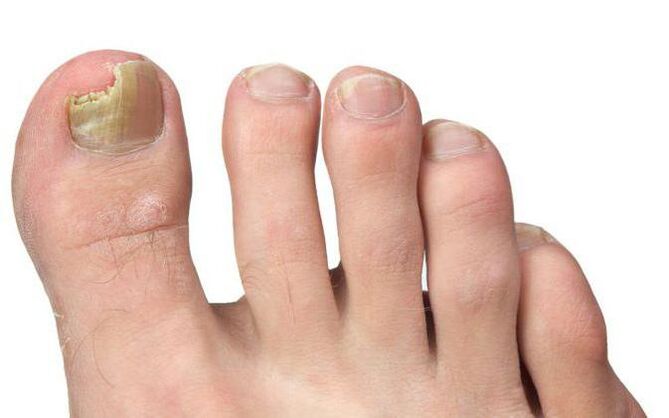 Fungus on the thumbs