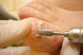 The mechanical cutting of the nail plate