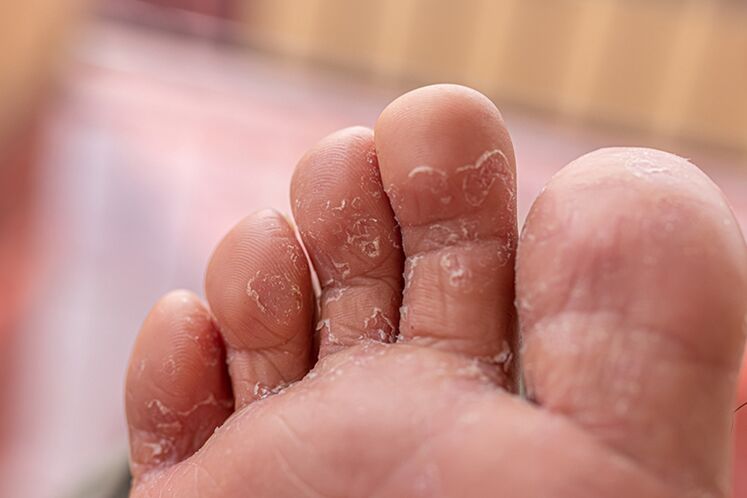 Finger Skin Fungus - Early stage