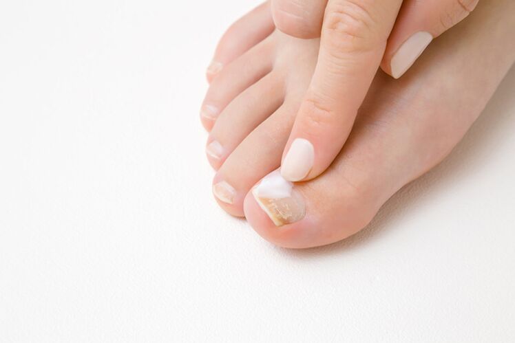 Finger treatment with ointment from fungus