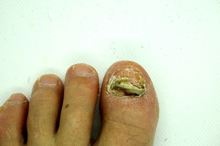 Fingernail fungus - heavy levels