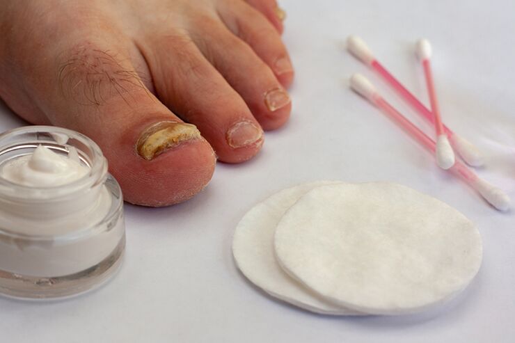 Fungers Fingers Treatment With Cream from fungus