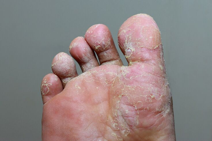 The degree of mycosis of the skin is severe