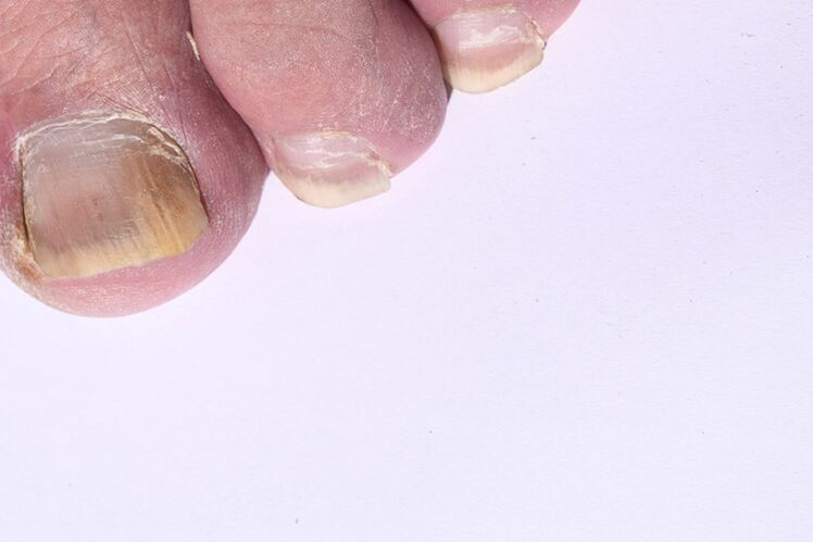The early stages of micosis of the nails in the legs