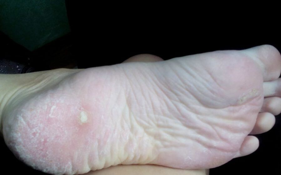 How the fungus looks and real