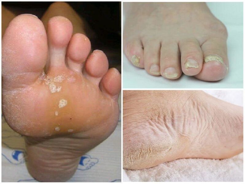 Symptoms of micosis