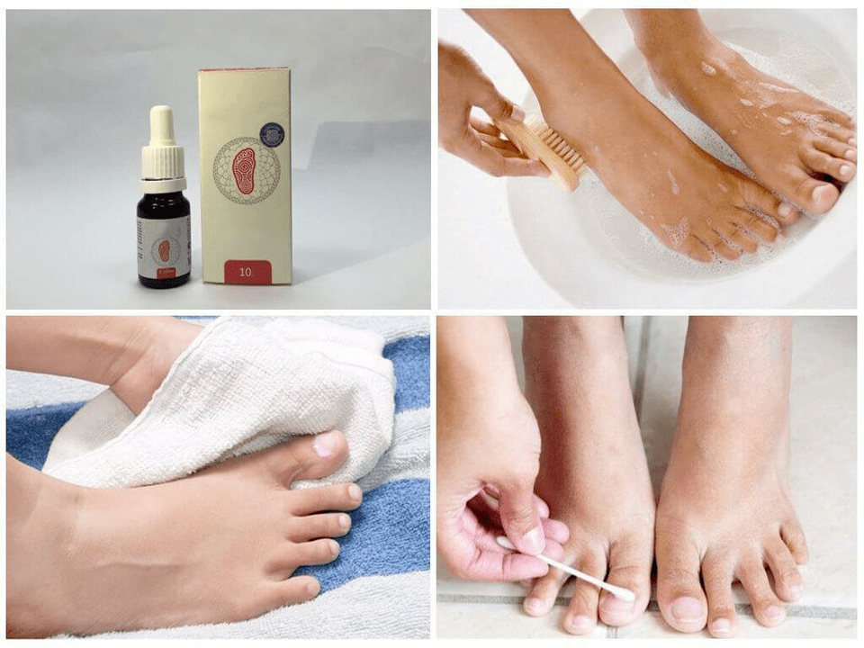 A variety of remedies for foot fungus