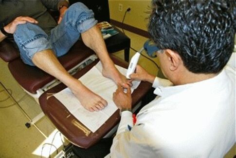 Removal of laser nail fungus