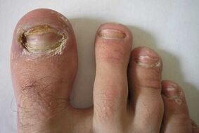 Damage to the nail plate on the toe due to fungal infection