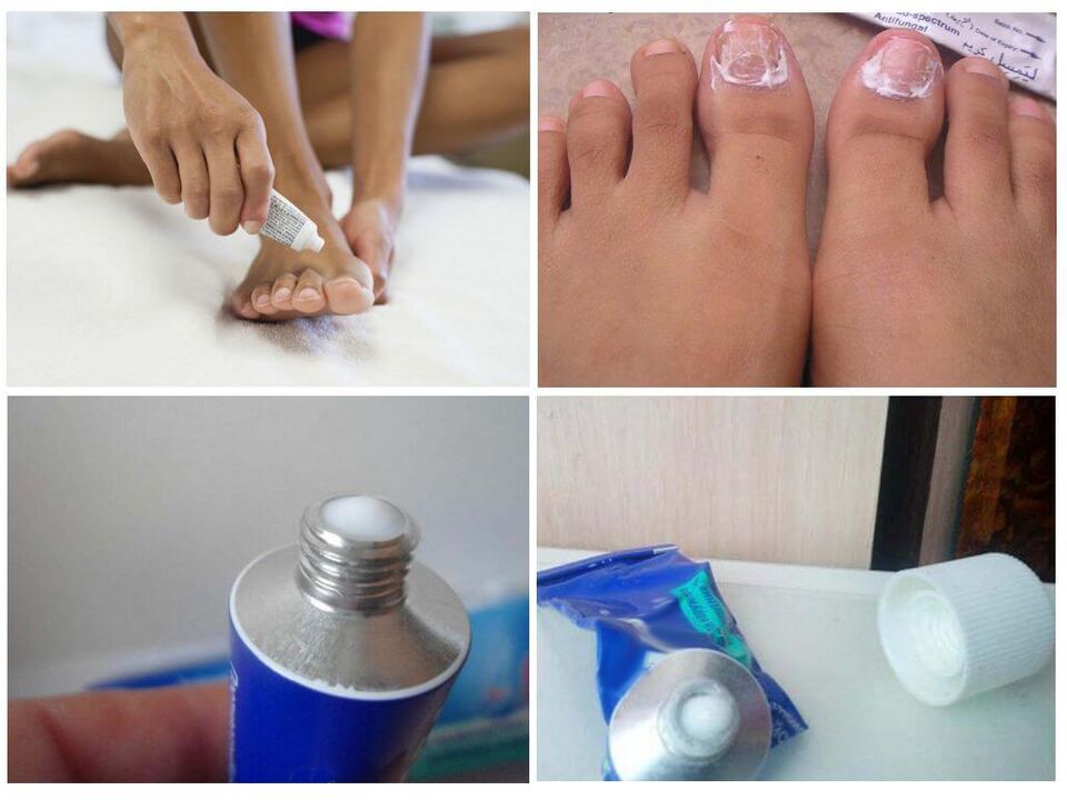 pharmaceutical preparations that are effective against nail fungus