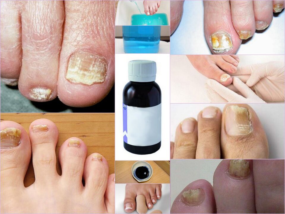 remedy for toenail fungus