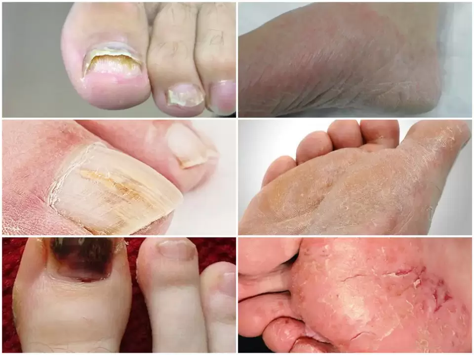 Fungal manifestations on the feet from various pathogens