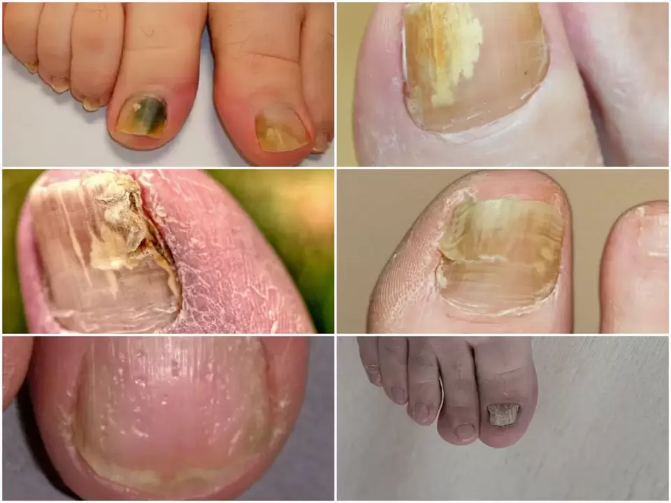 Symptoms of onychomycosis - changes in the color and structure of the nail