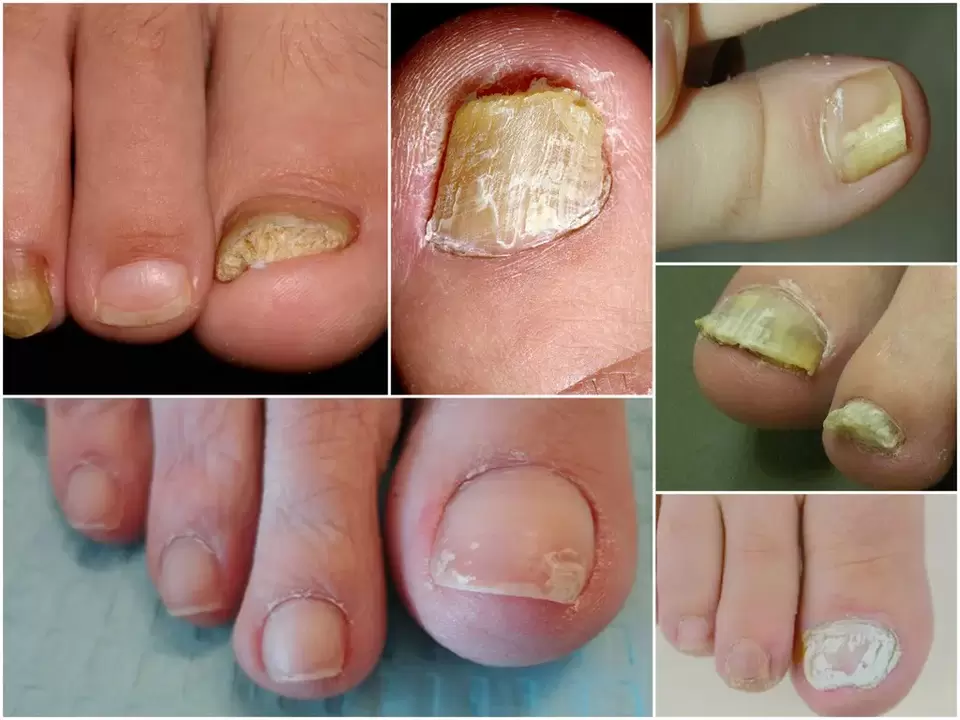 The emergence of various forms of onychomycosis