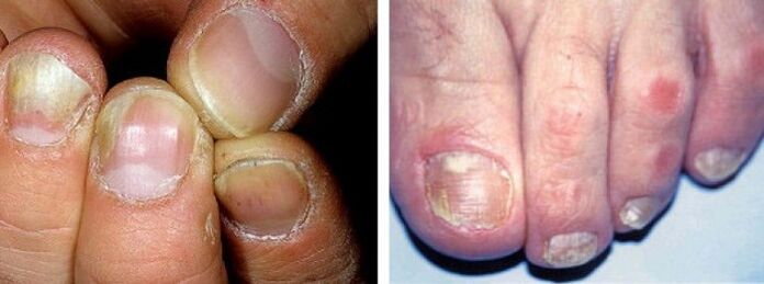 manifestations of fungal infections on the nails