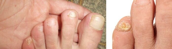 photos of fungal manifestations on toenails