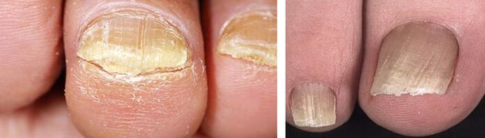 damage to nails with fungal infections
