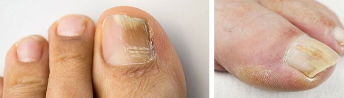 pictures of fungal infections on toenails
