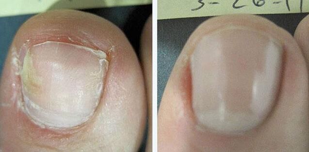 before and after nail fungus treatment