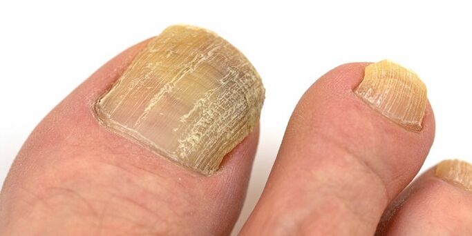 damage to nails with further fungal infections