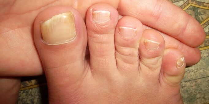 damage to toenails by fungus