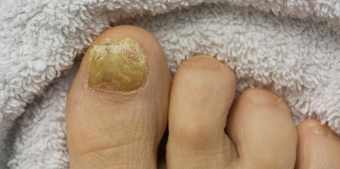yellow nails with fungal infections