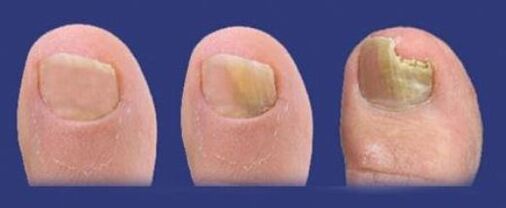 stage of fungal development on toenails