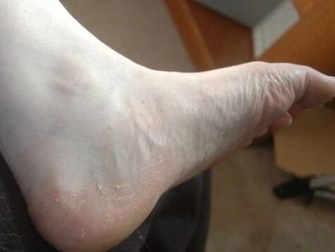 peeling off the feet as a sign of a fungal infection