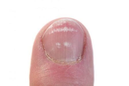 early stages of nail fungus infection