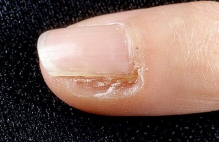 partial removal of nails with fungus